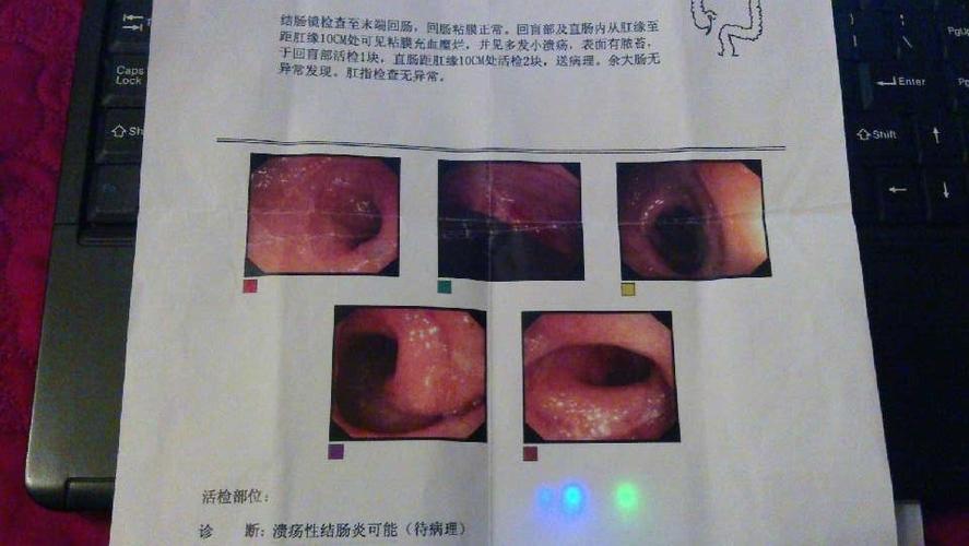 溃疡性结肠炎如何切断基因传播