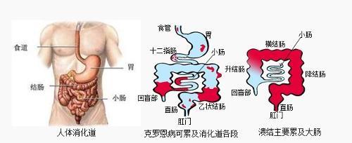 怎样判断溃疡性结肠炎的轻重