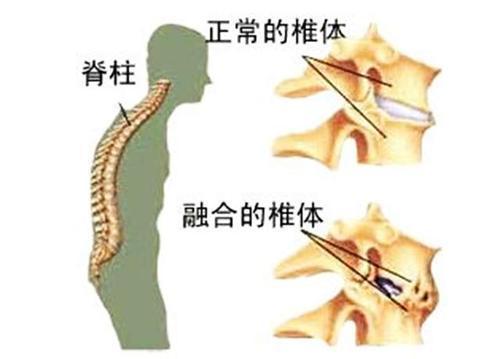 男孩强直性脊柱炎早期症状怎么办