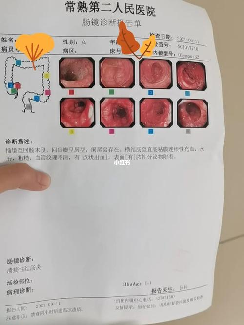 溃疡性结肠炎竟拉水便怎么办