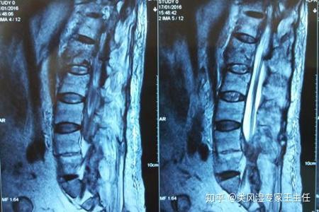 强直性脊柱炎可以从胸椎发病吗