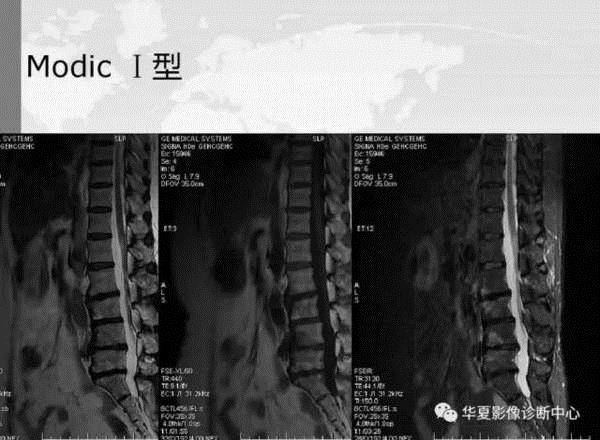 强直性脊柱炎椎体骨折