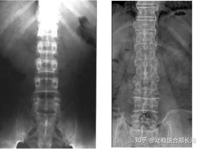 强直性脊柱炎影响寿命