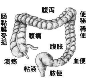 溃疡性结肠炎会引起肺病吗