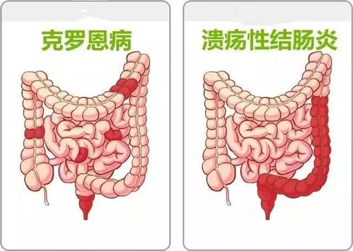 溃疡性结肠炎喝什么增强体质