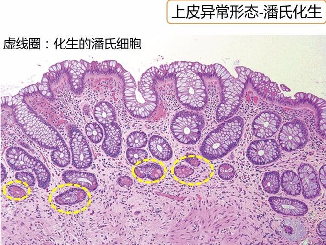 溃疡性结肠炎腹膜增厚