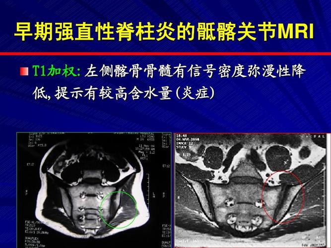 强直性脊柱炎会导致眼睛肿吗