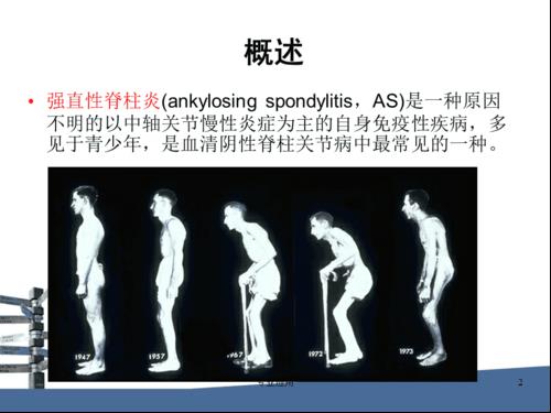 ?强直性脊柱炎