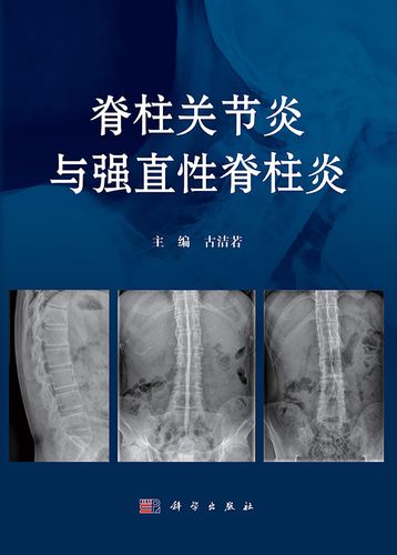 强直性脊柱炎目前治愈不了吧