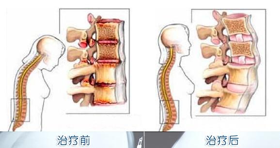 长蛇灸做多久能治好强直性脊柱炎