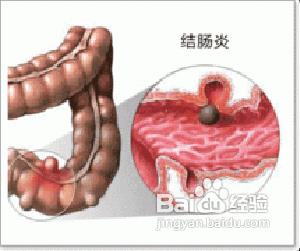 难治性溃疡性结肠炎