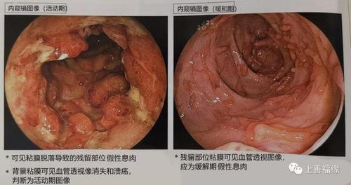 溃疡性结肠炎做大便化验