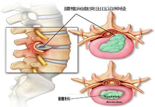 上半个背痛是强直性脊柱炎