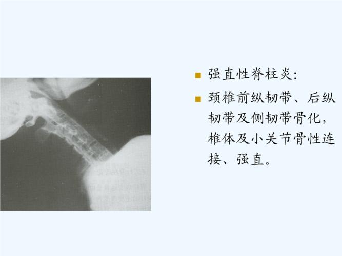 强直性脊柱炎会引起心脏疼么