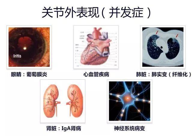 脐带血强直性脊柱炎