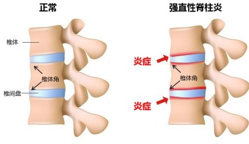 交通事故加重强直性脊柱炎