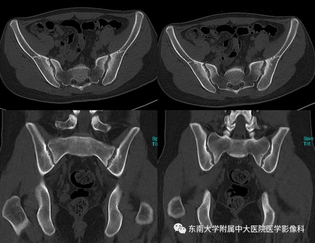 强直性脊柱炎会引起口干牙齿微痛