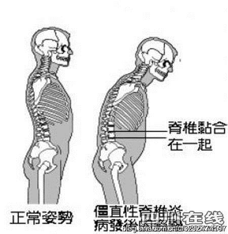 强直性脊柱炎治疗好后的康复