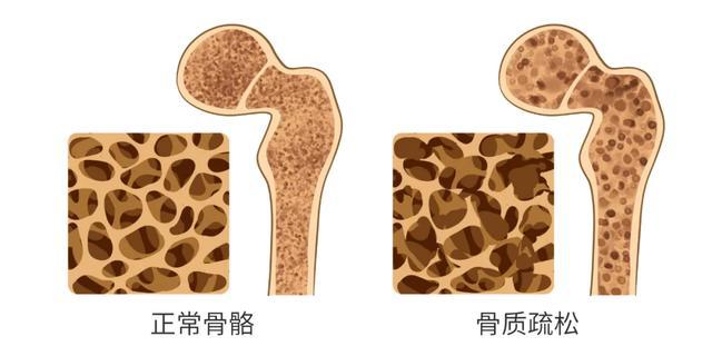 强直性脊柱炎与骨质增生有关系吗