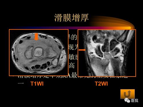 风湿和强直性脊柱炎同时存在