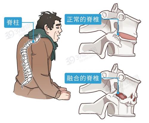 强直性脊柱炎理疗仪器有哪些