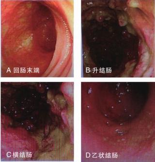 溃疡性结肠炎诊断依据