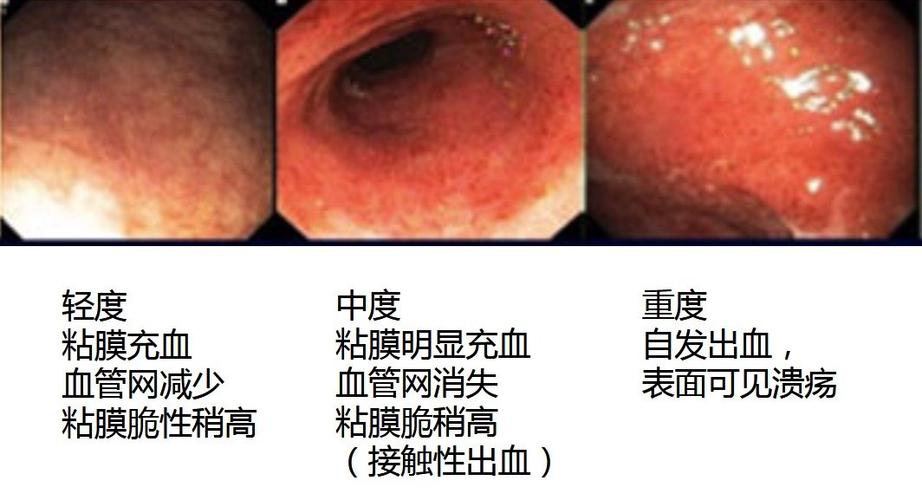 溃疡性结肠炎微创怎么治疗