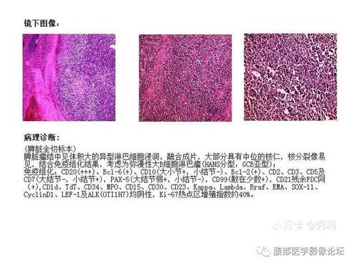 弥漫性大B细胞淋巴瘤