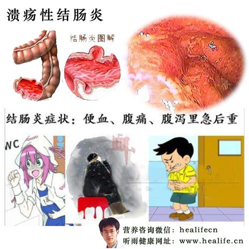 牙根部溃疡性结肠炎