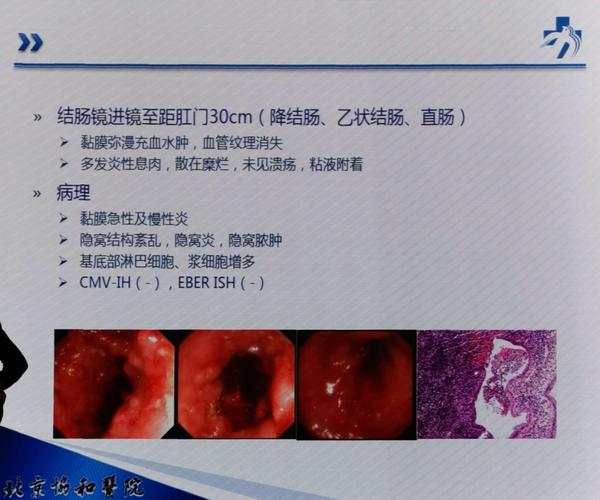 溃疡性结肠炎镜下特点