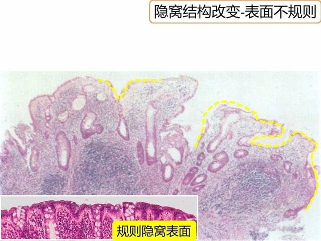 溃疡性结肠炎属于消化溃疡吗