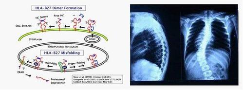 强直性脊柱炎是不是igg4