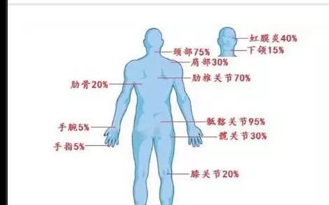 类风湿性关节炎跟强直性脊柱炎有什么区别