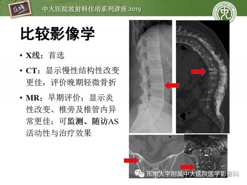 强直性脊柱炎早期检测