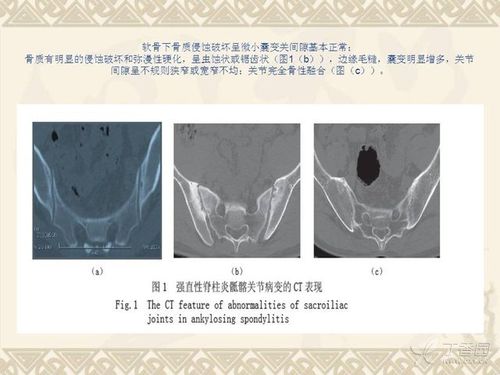 全身性骨关节炎和强直性脊柱炎