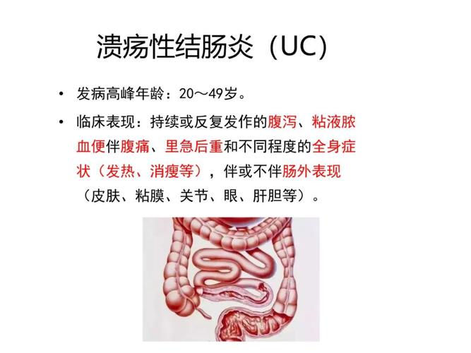 胃病误诊溃疡性结肠炎