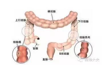 老公溃疡性结肠炎