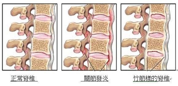 治强直性脊柱炎病