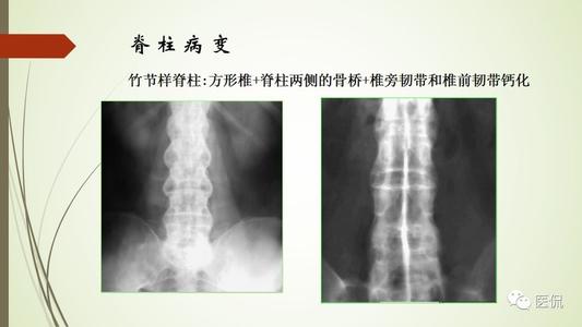 强直性脊柱炎什么原因