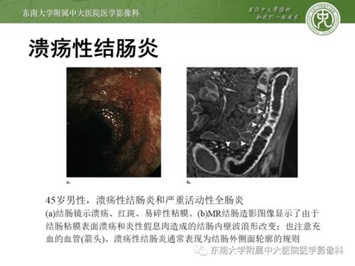 溃疡性结肠炎的血常规