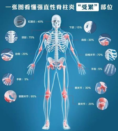 强直性脊柱炎低热