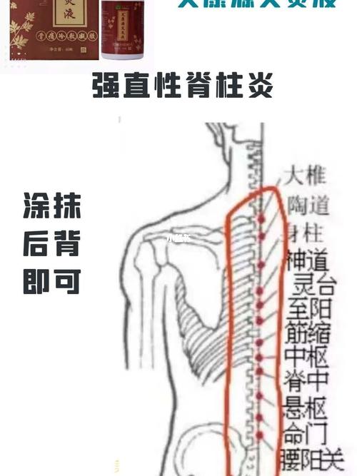 强直性脊柱炎后脑头痛