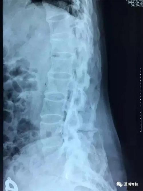 华米强直性脊柱炎治疗方法