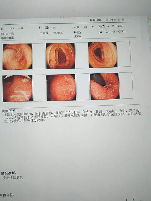 军人患溃疡性结肠炎怎么办