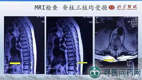 强直性脊柱炎哪家医院好