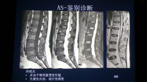 幼儿强直性脊柱炎