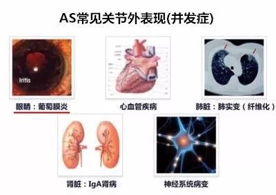 强直性脊柱炎会白细胞计数偏高吗