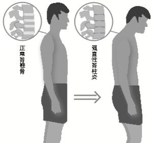 强直性脊柱炎阴性