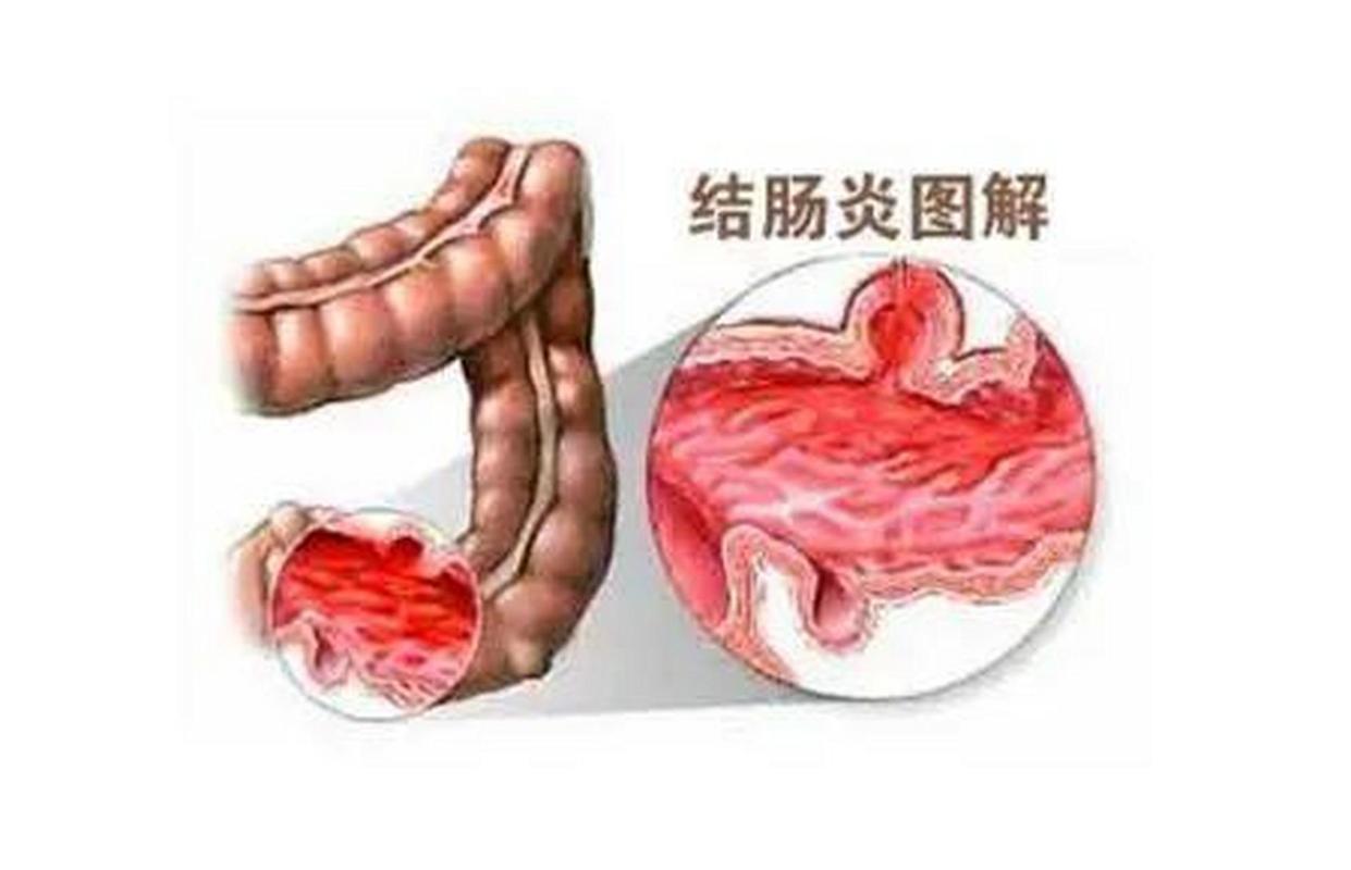 溃疡性结肠炎积极治疗还会癌变吗