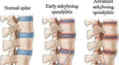 强直性脊柱炎驼背的前兆